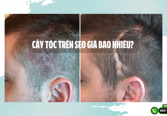 Cấy tóc trên sẹo giá bao nhiêu? Địa chỉ cấy tóc trên sẹo uy tín chất lượng