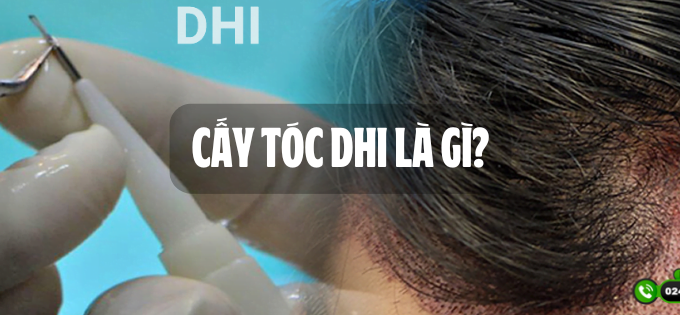 Cấy tóc DHI là gì? Lời khuyên của chuyên gia khi lựa chọn phương pháp cấy tóc 