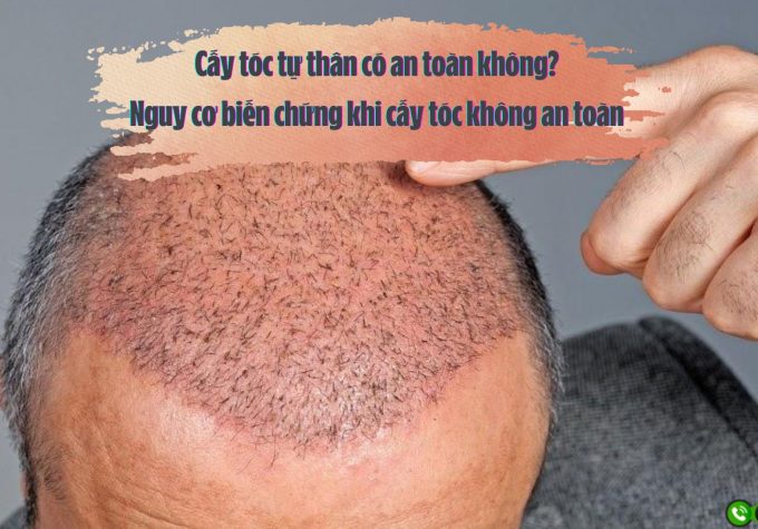 Cấy tóc tự thân có an toàn không? Nguy cơ biến chứng khi cấy tóc không an toàn 