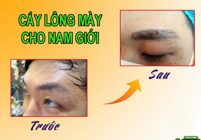 Cấy lông mày cho nam giới – nâng tầm đẳng cấp, thay đổi tài vận