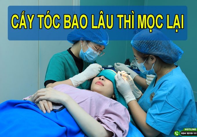 Cấy tóc bao lâu thì mọc lại? Review tiến trình mọc tóc theo từng giai đoạn