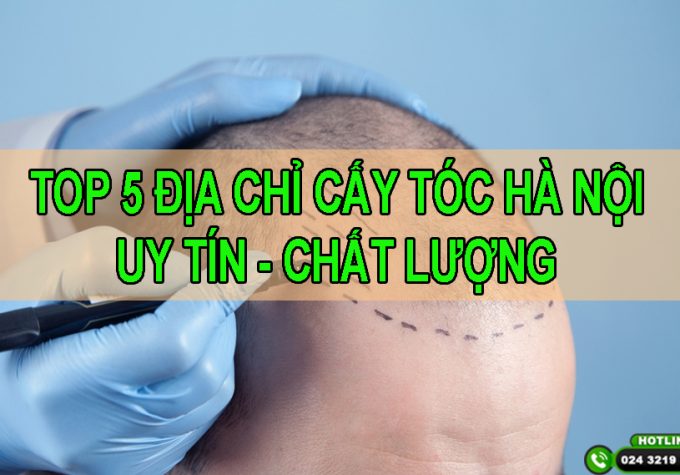 TOP 5 địa chỉ cấy tóc Hà Nội uy tín và chất lượng nhất!