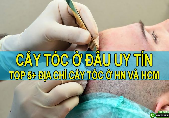 Cấy tóc ở đâu uy tín? TOP 5 địa chỉ cấy tóc uy tín tại Hà Nội và TP. Hồ Chí Minh