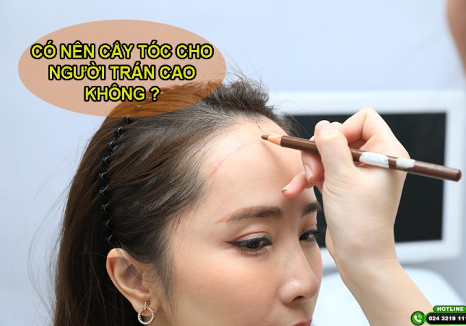 [Tìm Hiểu] : Có nên thực hiện cấy tóc trán cao không?