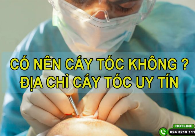 Có nên cấy tóc không? Bật mí địa chỉ cấy tóc chất lượng