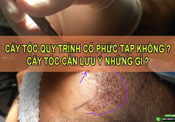 Cấy tóc quy trình có phức tạp không và cần lưu ý những gì?