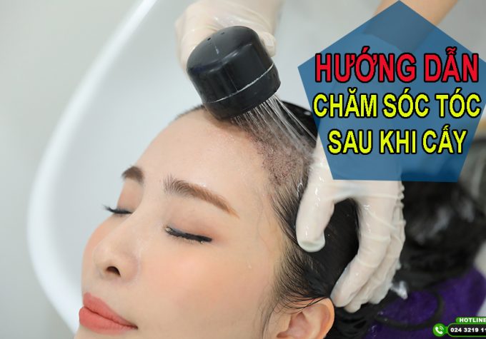 Hướng dẫn chăm sóc sau khi cấy tóc sao cho hiệu quả