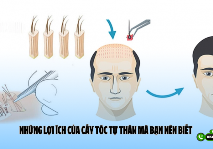 Những lợi ích của cấy tóc tự thân mà bạn nên biết 