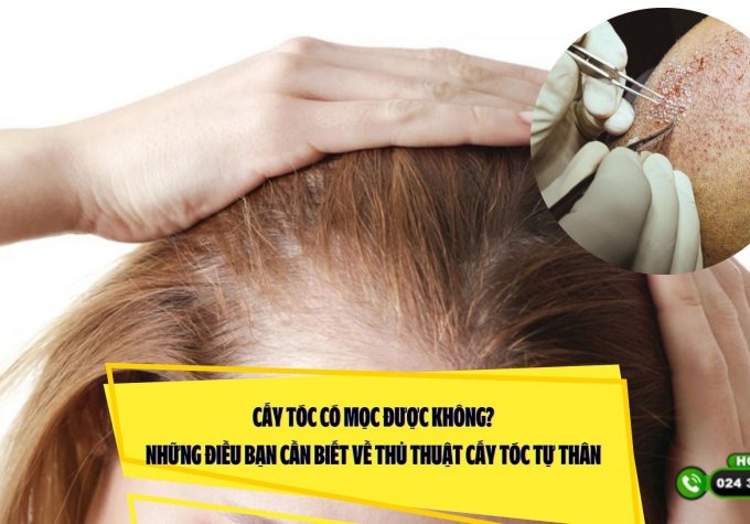 Cấy tóc có mọc được không? Những điều bạn cần biết về thủ thuật cấy tóc tự thân 