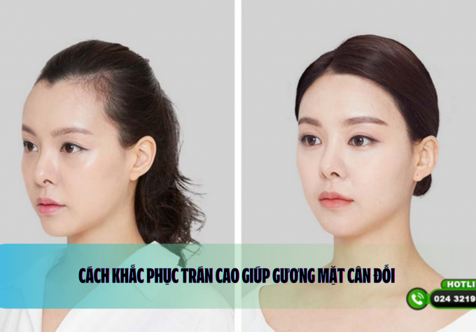 Cách khắc phục trán cao giúp gương mặt cân đối 