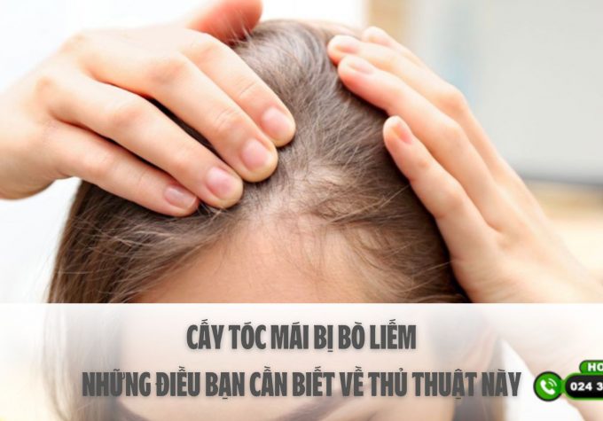 Cấy tóc mái bị bò liếm: những điều bạn cần biết về thủ thuật này