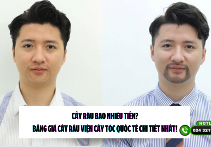 [Giải đáp] Cấy râu bao nhiêu tiền? Bảng giá cấy râu Viện Cấy tóc Quốc tế chi tiết nhất! 