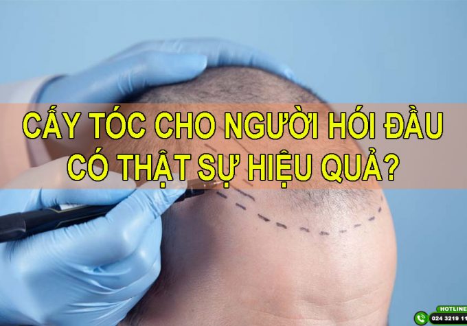 Cấy tóc cho người hói thật sự mang lại hiệu quả cao như quảng cáo?