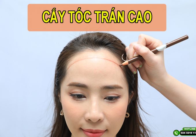 Cấy tóc trán cao – Giải pháp khắc phục trán sân bay hiệu quả