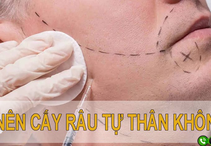 Có nên cấy râu tự thân hay không? Mách bạn địa chỉ cấy râu uy tín