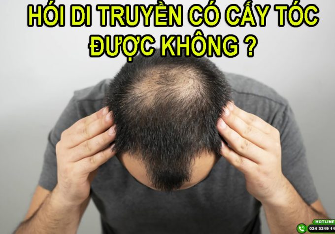 Chuyên gia giải đáp: Hói di truyền có cấy tóc được không?