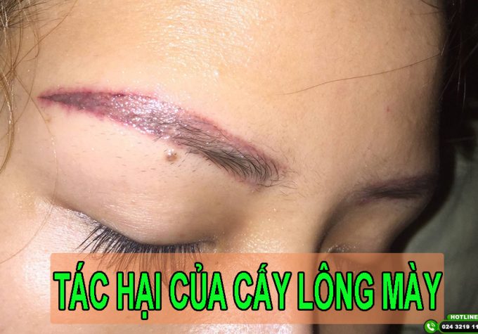 Tác hại cấy lông mày và lời khuyên giúp bạn thực hiện thủ thuật an toàn, không biến chứng