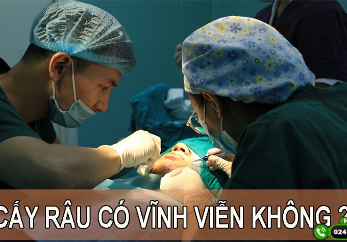 Cấy râu có vĩnh viễn không? Chuyên gia giải đáp chi tiết nhất!