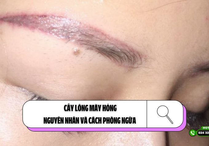 Cấy lông mày hỏng: nguyên nhân và cách phòng ngừa 