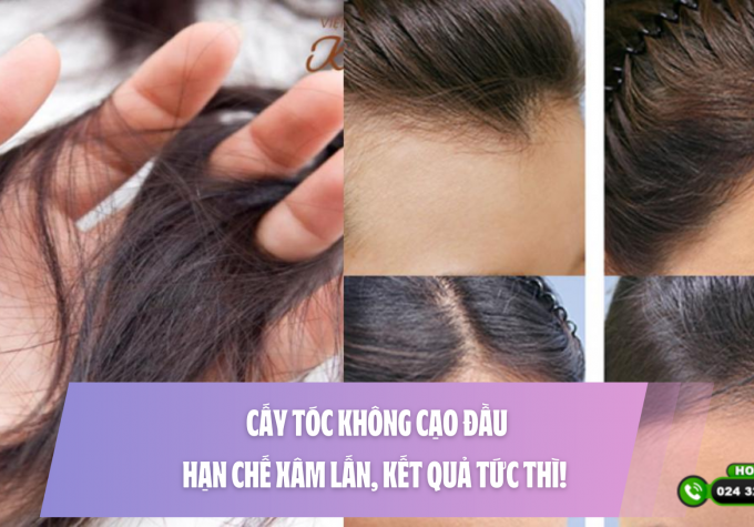 Cấy tóc không cạo đầu: hạn chế xâm lấn, kết quả tức thì! 