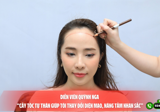 Diễn viên Quỳnh Nga “Cấy tóc tự thân giúp tôi thay đổi diện mạo, nâng tầm nhan sắc”