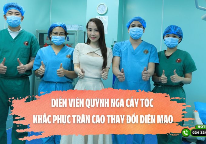 Diễn viên Quỳnh Nga cấy tóc khắc phục trán cao thay đổi diện mạo