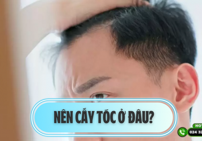 Nên cấy tóc ở đâu? Bật mí địa chỉ cấy tóc uy tín được Sao Việt tin chọn