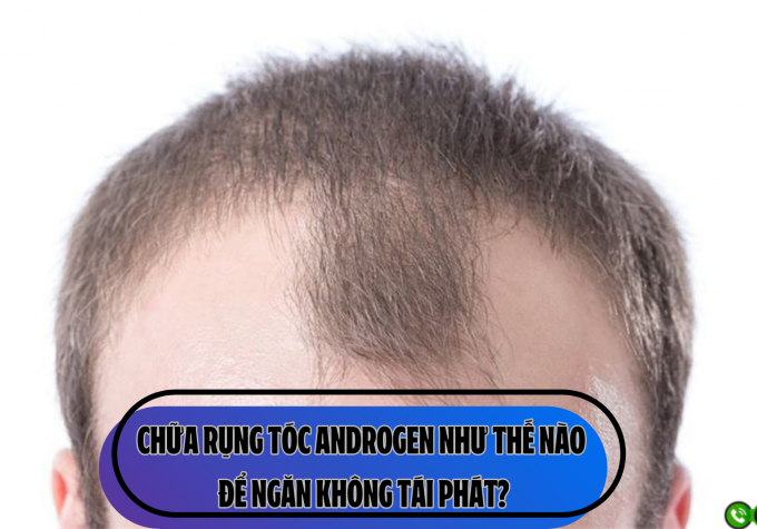 Chữa rụng tóc Androgen như thế nào để ngăn không tái phát?