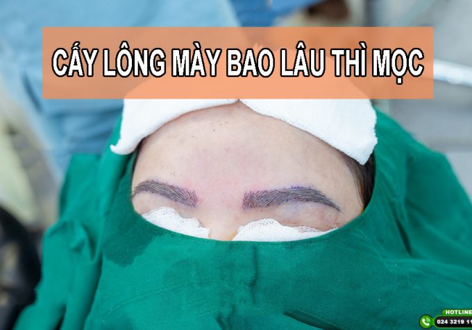 Cấy lông mày bao lâu thì mọc? Cấy lông mày duy trì được bao lâu?