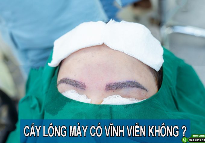 Thực hư việc cấy lông mày có được vĩnh viễn không?