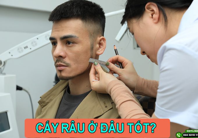 Cấy râu ở đâu tốt? Top 3 địa chỉ cấy râu uy tín tốt nhất hiện nay