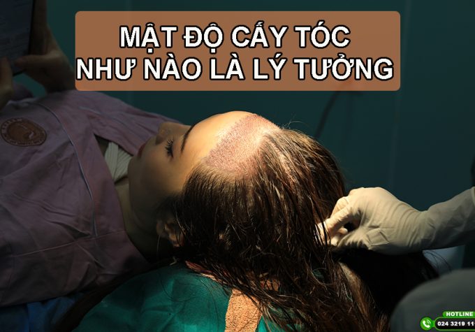 Mật độ cấy tóc bao nhiêu là lý tưởng và những điều cần lưu ý khi cấy tóc