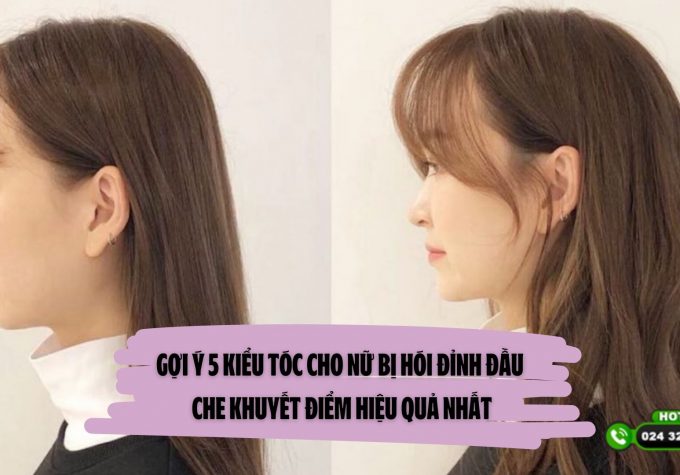 Gợi ý 5 kiểu tóc cho nữ bị hói đỉnh đầu che khuyết điểm hiệu quả nhất