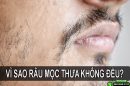 Vì sao râu mọc thưa không đều và 5 cách cải thiện tình trạng này