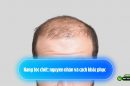 Nang tóc chết: nguyên nhân và cách khắc phục 