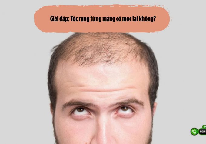 Giải đáp: Tóc rụng từng mảng có mọc lại không?
