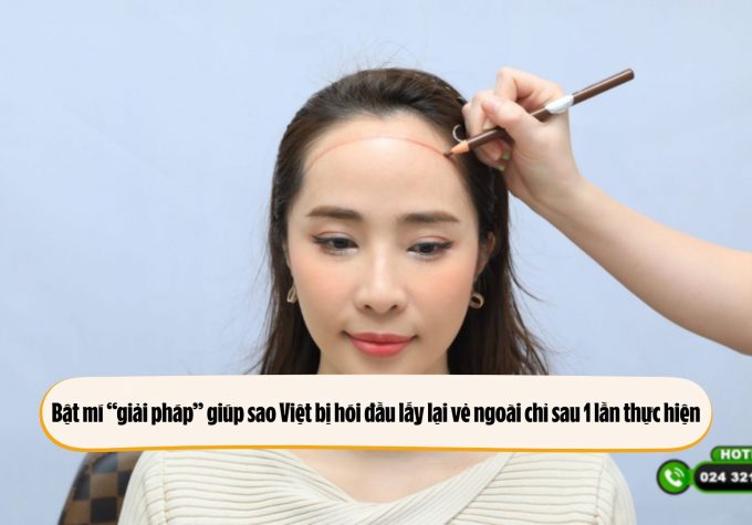 Bật mí “giải pháp” giúp sao Việt bị hói đầu lấy lại vẻ ngoài chỉ sau 1 lần thực hiện