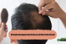 Bị hói giữa đầu nguyên nhân do đâu và cách điều trị như thế nào? 