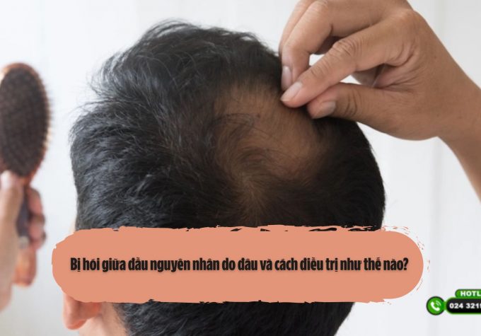 Bị hói giữa đầu nguyên nhân do đâu và cách điều trị như thế nào? 