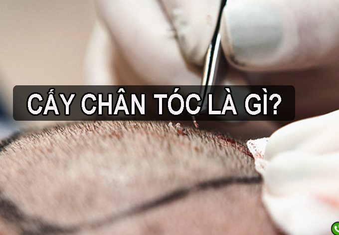 Cấy chân tóc là gì? Hiểu đúng về thủ thuật cấy tóc