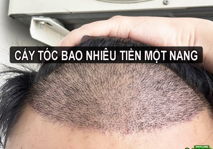 Cấy tóc bao nhiêu tiền một sợi? Bảng giá chi tiết