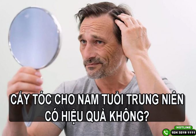 Cấy tóc cho nam giới tuổi trung niên có hiệu quả không?