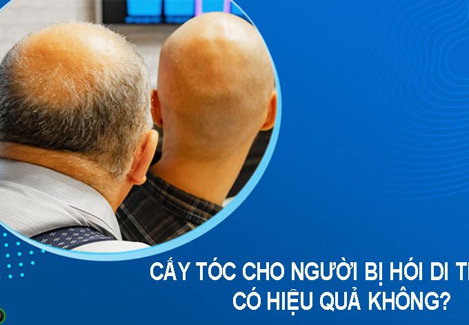 Cấy tóc cho người bị hói di truyền có hiệu quả không?