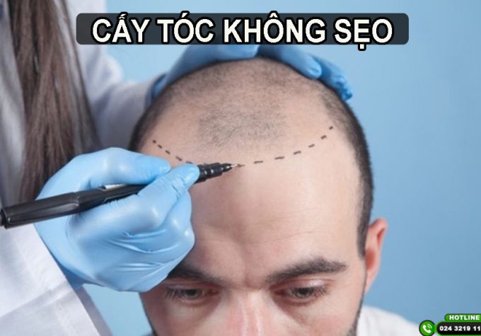 Cấy tóc không sẹo: Lựa chọn thông minh cho người hói đầu