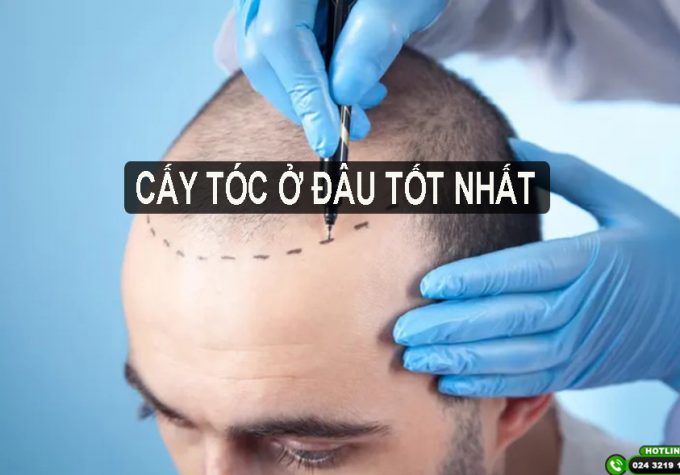 Cấy tóc ở đâu tốt nhất? Mách bạn địa chỉ cấy tóc uy tín tại Hà Nội và TP. Hồ Chí Minh