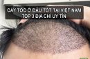 Cấy tóc ở đâu tốt tại Việt Nam? Gợi ý 3 địa chỉ hàng đầu hiện nay