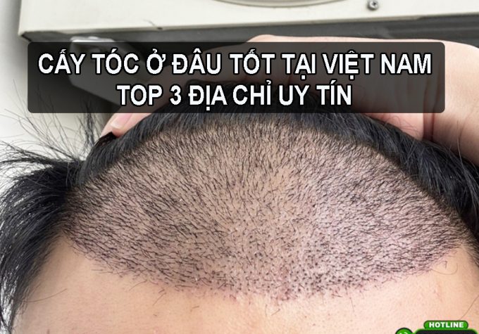 Cấy tóc ở đâu tốt tại Việt Nam? Gợi ý 3 địa chỉ hàng đầu hiện nay