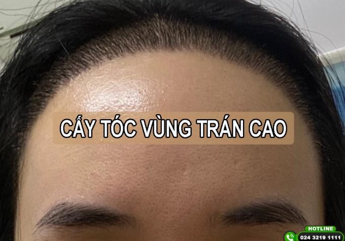 Cấy tóc vùng trán cao có hiệu quả không? Chi phí và lưu ý quan trọng trước khi cấy