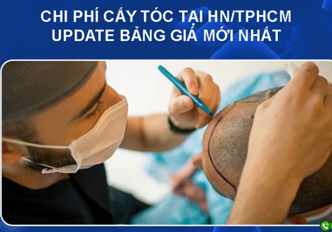 Tìm hiểu chi phí cấy tóc tại HN/TP.HCM, Update bảng giá cấy tóc mới nhất