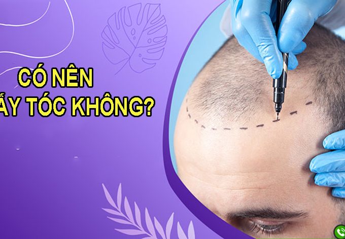 Có nên đi cấy tóc không? Hiệu quả cấy tóc thực tế